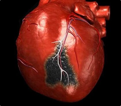Infarto de miocardio