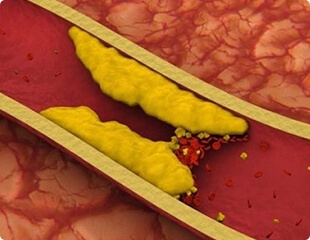 Placas de colesterol